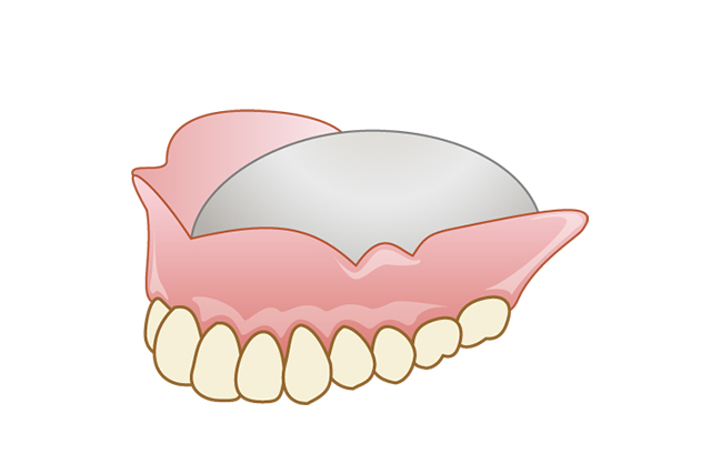 自費の金属床入れ歯