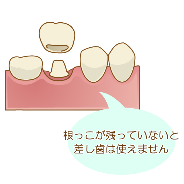 根っこが残っていないと差し歯は使えません