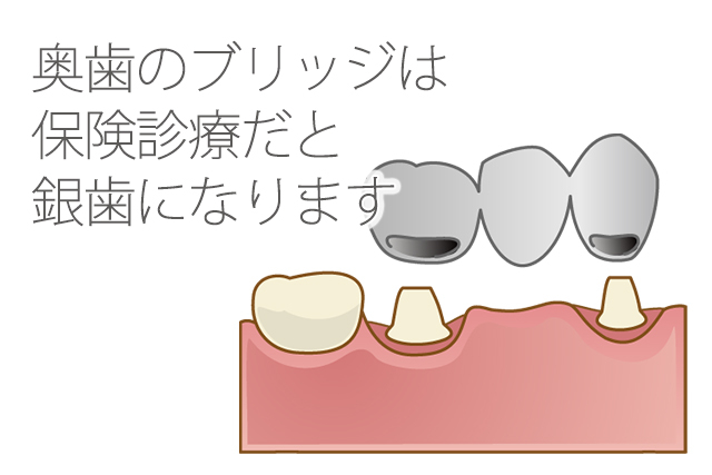 保険の場合奥歯のブリッジは銀歯になる