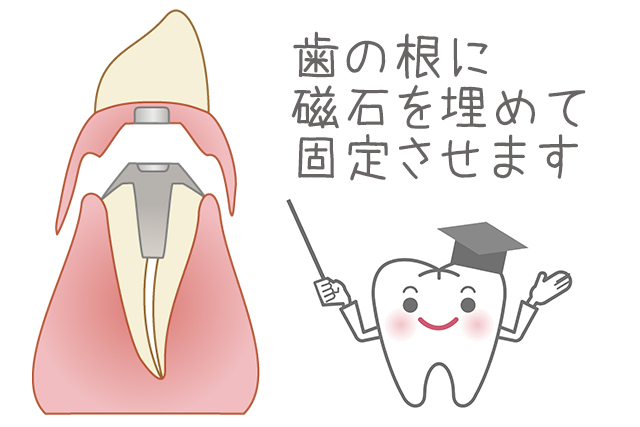 歯の根に磁石を埋めて固定